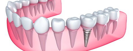 Single dental implant in mouth mold