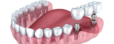 Digital image of an implant bridge