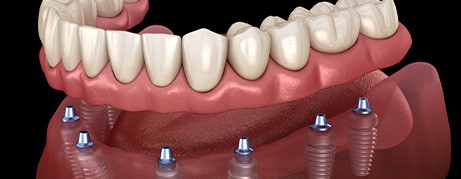 Detailed look at an implant denture 