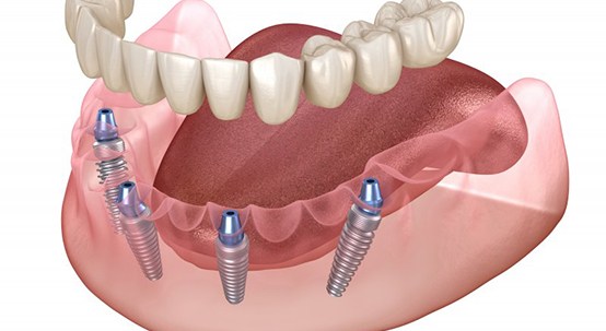 Illustration of All-on-4 denture