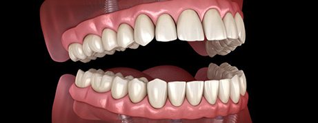 Illustration of All-on-4 dentures