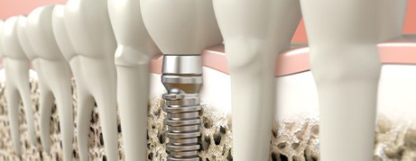 Dental implant inserted into jawbone