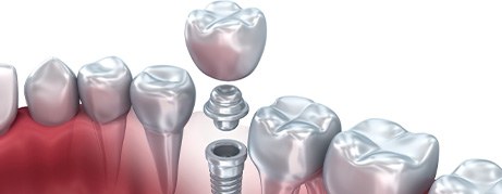 Model showing each part of a dental implant