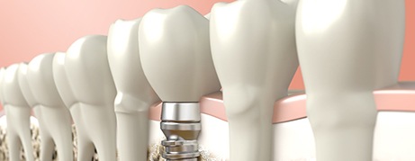 Digital illustration of a dental implant