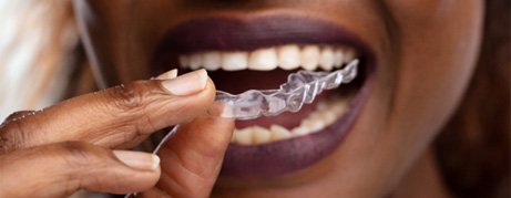 Smiling patient putting on clear aligner