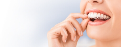 Person placing a clear aligner over their teeth