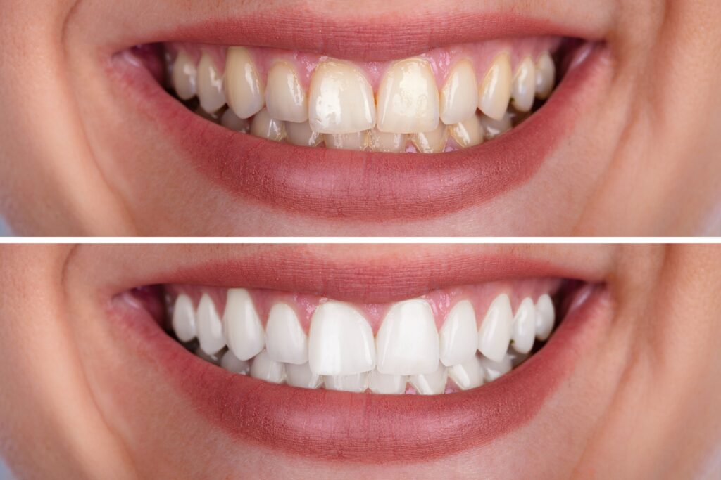 Before and after teeth whitening photos to show results